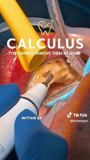 Understanding Plaque and Calculus: Dental Care Essentials