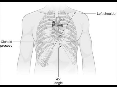 Pericardiocentesis; medical procedure to remove fluid from the pericardial sac