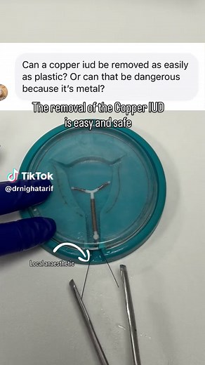Copper Coil IUD Removal Explained