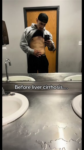 Dr. Kliment & DR. Ariel did a FINE job on my incision. Very straight line work all along my rib cage. We have the before transplant and right after transplant. Lost 65 pounds & I am now 4 months post transplant and just started hitting the gym again 2 and a half weeks ago. I’ve gained about 10 pounds already 💪🏼 Well be back soon 💪🏼 #livercirrhosis #liverdisease #livertransplant #transplant #autoimmunedisease