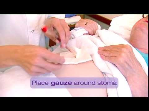 Gastrostomy Tube (G-Tube) placement