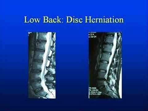 Low Back Anatomy with pinched nerves, disc ruptures & pain