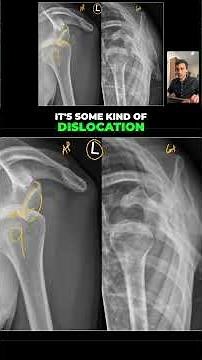 Anterior vs Posterior Shoulder dislocation cases (Part 1)
