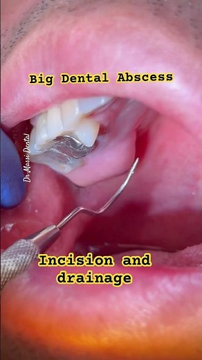 Big Dental Abscess, Incision and drainage
