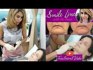 Mouth Wrinkles? How to Treat Marionette Lines with Dermal Filler