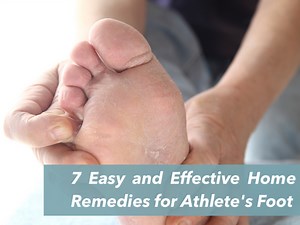 7 Easy and Effective Home Remedies for Athlete's Foot