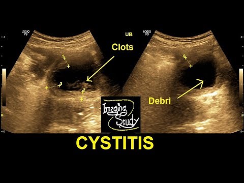 Cystitis || Ultrasound || Case 29