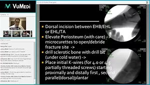 Navicular Fractures: Acute Trauma or Chronic Injury