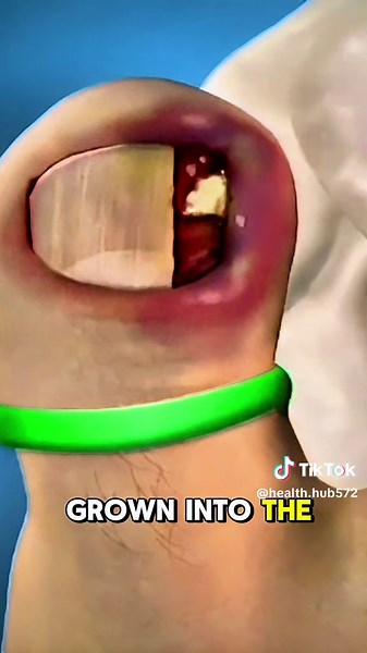 Ingrown Toenail Removal: 3D Medical Animation