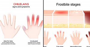Knowing The Differences Between Chilblains And Frostbite Could Save Your Fingers