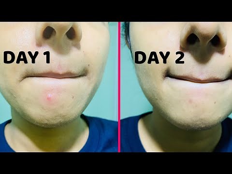 How to remove PIMPLES Overnight | Pimples removal Naturally Before and After