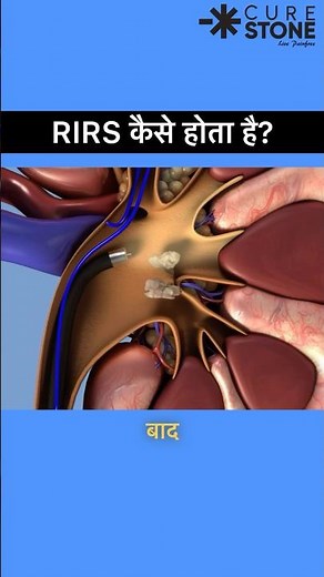Kidney stones treatment animation | RIRS | Retrograde Intrarenal Surgery Animation #rirs |