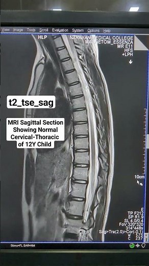MRI Sagittal Section View Showing Normal Cervical-Thoracic Spine Sequence Planning #beginners