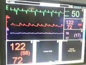 9.2K views · 26 reactions | Post op cardiac patient had this rhythm in the ECG trace in the monitor. Its ventricular Bigeminy. One can see each normal beat is alternating with a ventricular premature complex (VPC). If you see the arterial line trace below it, during the VPC there is no effective contraction as shown by very small amplitude arterial waveform :) | Medical Snippet | Facebook