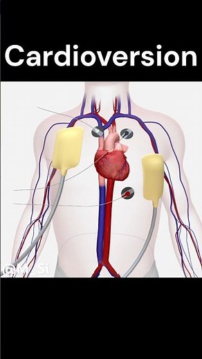 Cardioversion