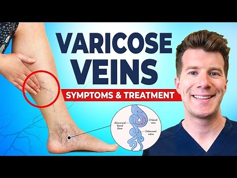 Varicose Veins Explained: Causes, Symptoms & Treatment