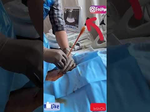Ultrasound guided suprapubic catheter insertion |Dr.Naveen Kumar Goda | Interventional radiologist
