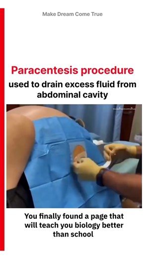💉Paracentesis procedure 💧 used to drain excess🫄 fluid from abdominal cavity 🫙| MDCT