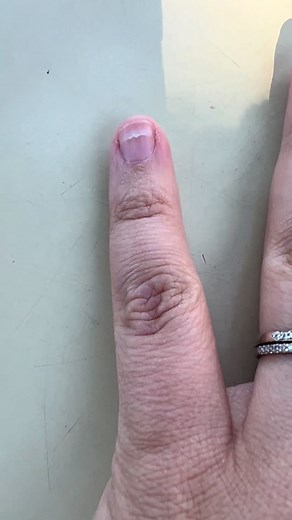 Observando cambios en las uñas durante la quimioterapia