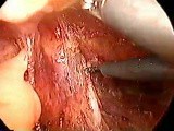 Laparoscopic abdominoperineal resection • Video • MEDtube.net