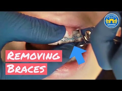 Process of Removing Braces