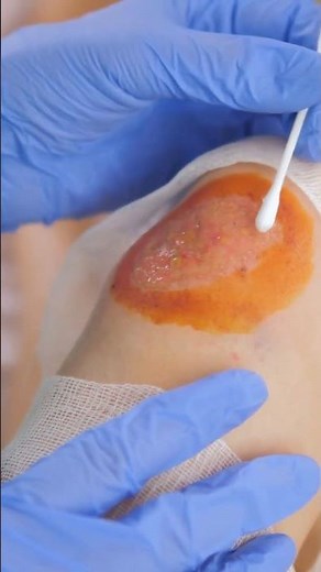 How to Perform a Sterile Wound Dressing Change | RN Explains 123 Step-by-Step