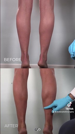 Transform Your Legs with Liposuction: Before and After Results Revealed!