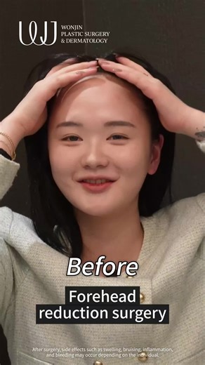Forehead Reduction Surgery – Before & After Reveal! ✨👩‍⚕️ Watch this transformation from start to finish — lower hairline, more balanced proportions, and boosted confidence. Forehead reduction isn't just cosmetic—it's about harmony and feeling your best 💫 Over 20 years of experience and heritage you can trust. -WJ Wonjin —————————————————————————— Contact us for a FREE consultation🫶🏼 📲 821049183309 🔗 www.wonjinbeauty.com 📩 english@kwj.co.kr 💬 Kakao|Line ID wonjineng 📮 Instagram DM —————