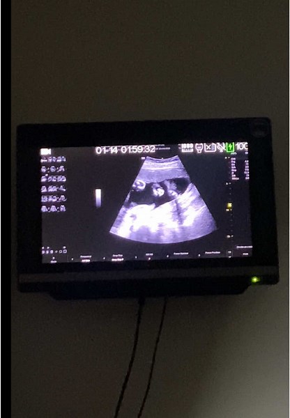 Congenital Anomaly Scan at 26 Weeks - Results Normal