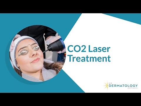 CO2 Laser for Fine Lines & Wrinkles