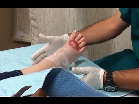 Large blood blister drainage