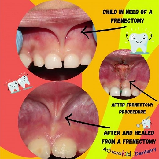 Pediatric labial frenectomy
