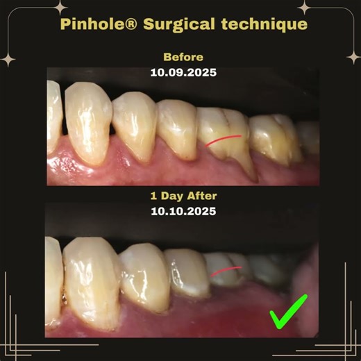 Gums Restored In 1 Session! One Day Later: See How the Gum Line Has Already Recovered