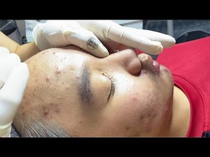Intense Acne Extraction | Removing Severe Red Pimples and Pus-filled Acne