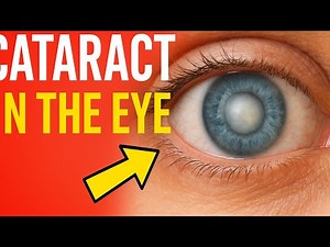 “Cataract: Causes, Symptoms, Treatment & Prevention | Don’t Ignore These Warning Signs!”