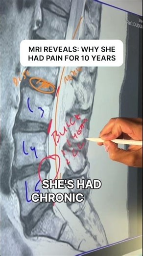 MRI found the real cause: disc bulge. Targeted decompression after 10+ yrs of pain #Shorts #MRI