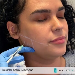 Masseter Botox Injections