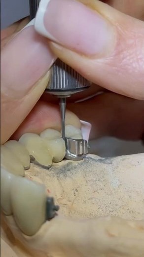 How a Partial Denture with Interlocks Is Made | Dental Lab Workflow