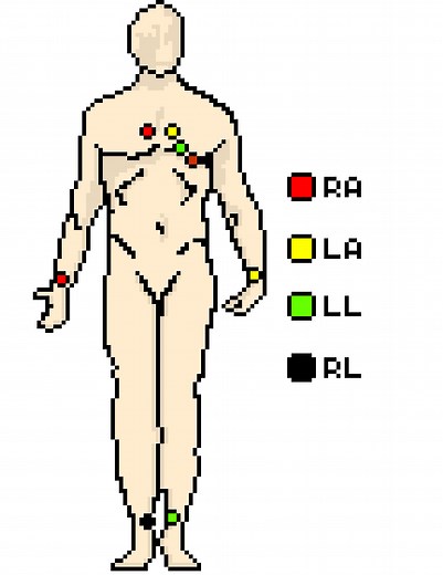 The ECG Leads, Polarity and Einthoven’s Triangle