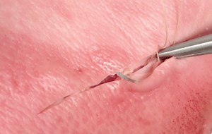 Running Subcuticular Suturing