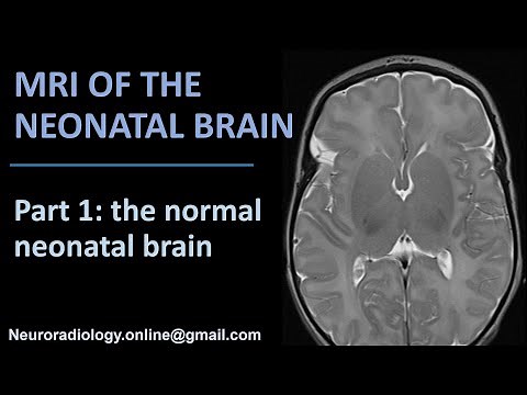 MRI of the Neonatal Brain, part 1: the normal neonatal brain.