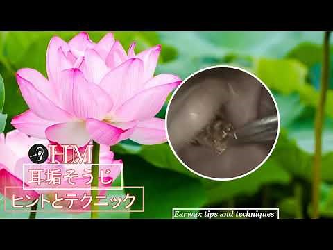 Eardrum about to 'EXPLODE' after Blocked Ear Wax Removal