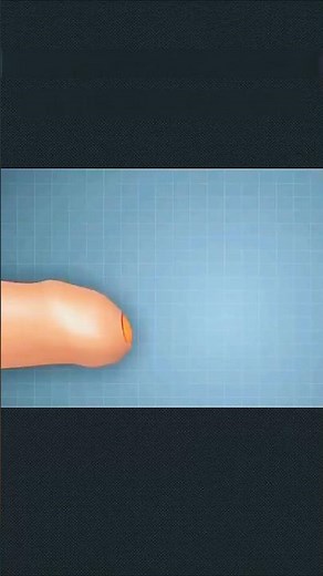 Como é feita a Cirurgia de FIMOSE? 🔬 (Postectomia Passo a Passo) #shorts #curiosidades #fimose