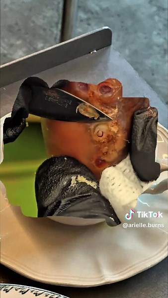 Effective Ways to Remove Jiggers Safely