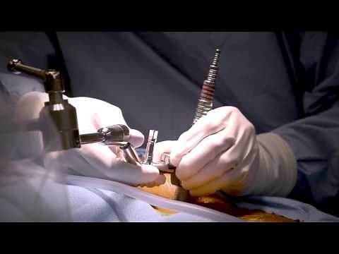 Minimally Invasive Laminectomy Surgery to Treat Lumbar Stenosis - MedStar Southern Maryland