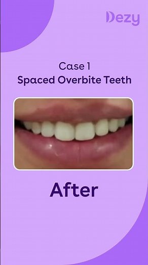 Clear Aligners Before and After Treatment Results | Transform Your Smile at Dezy