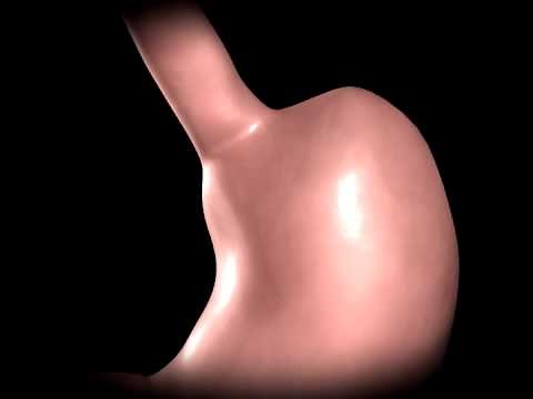 Gastric Bypass animation