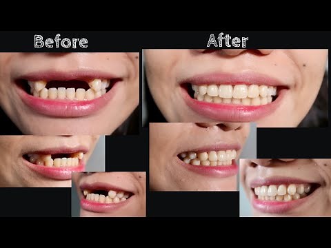 REMOVABLE PARTIAL DENTURE | Doc Noy