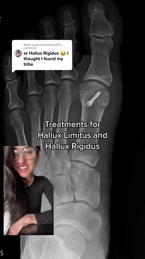 Hallux Limitus and Hallux Rigidus Treatment Options Explained