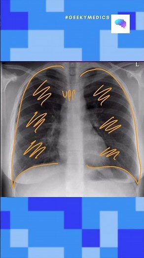 Chest X-ray Interpretation in 60 seconds - OSCE Guide | UKMLA | CPSA